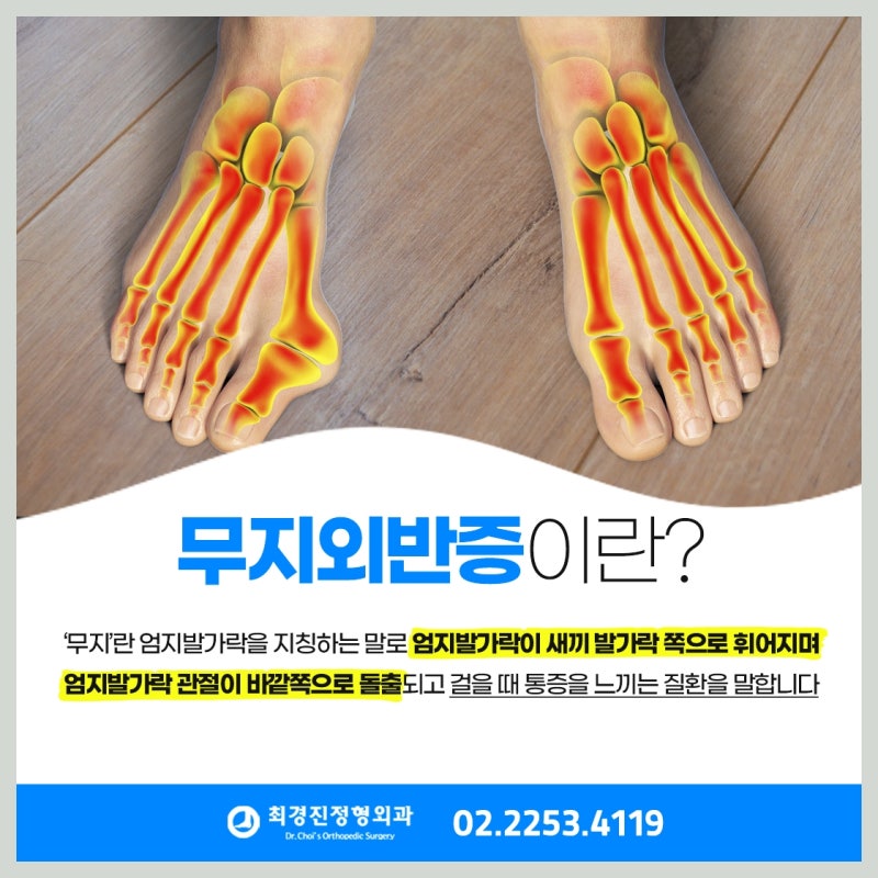 무지외반증 치료 방법, 수술 없이 가능한 경우와 필요한 경우 구분 기준