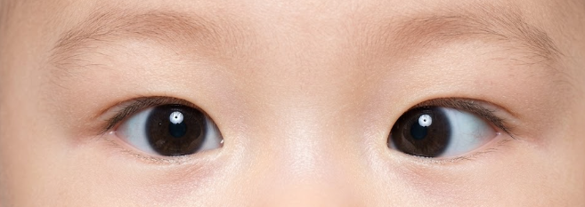  우리 아기 눈사시 아닐까? 신생아 유아 사시 증상 치료 내사시 외사시 차이