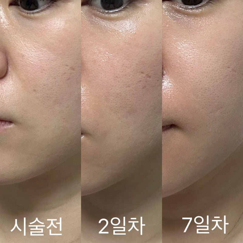 대전 피부과 나비존 모공관리 레이저 포텐자 후기(+ 가격 효과 통증 등)