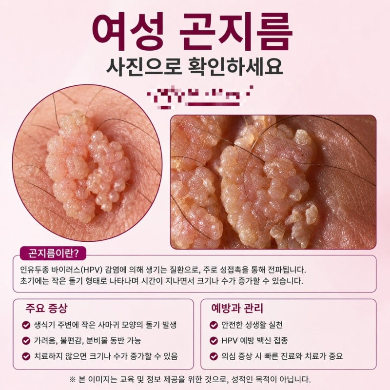 여드름과 구분해야 하는 여성 곤지름 모양 증상 사진으로 확인하세요