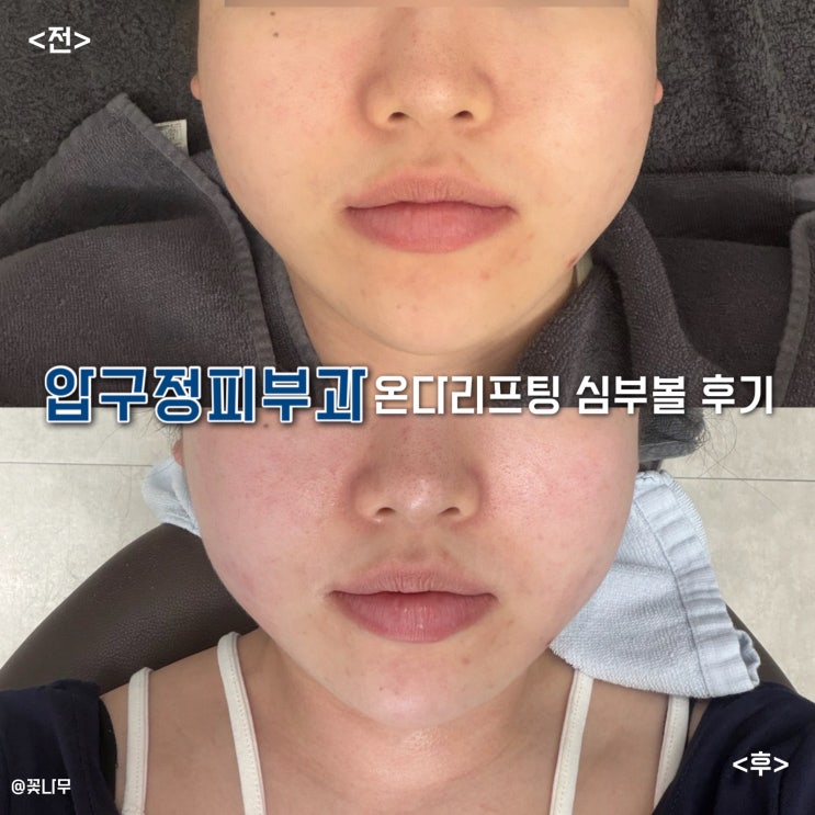  압구정피부과 온다리프팅 심부볼 정리 후기