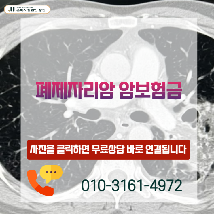  폐제자리암 암보험금, D02 코드 한 줄에 숨겨진 90%의 권리를 찾는 방법