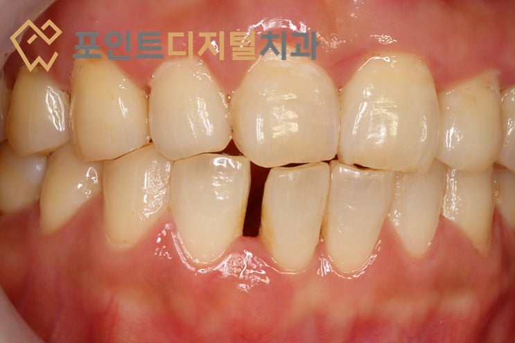 충북 괴산에서 아산 탕정까지, 아래 앞니 벌어짐 바이오클리어 레진 빌드업 (리뷰 감동 주의) / 천안 아산 충북 괴산에서 아산 탕정까지, 아래 앞니 벌어짐 바이오클리어 레진 빌드업 (리뷰 감동 주의) / 천안 아산
