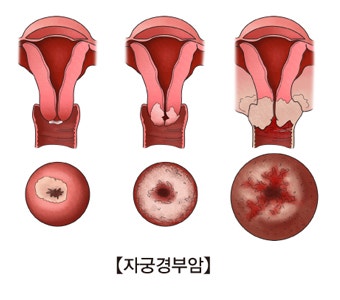 보험설계사가 알려주는 원추절제술 보장 체크포인트