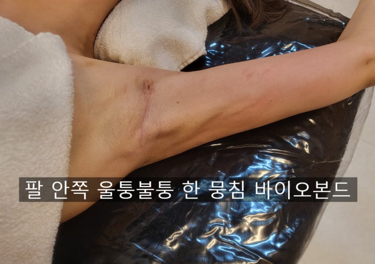  팔뚝 지방흡입 바본, 왜 더 울퉁해 보일까요? 붓기부터 바이오본드까지 실제 변화