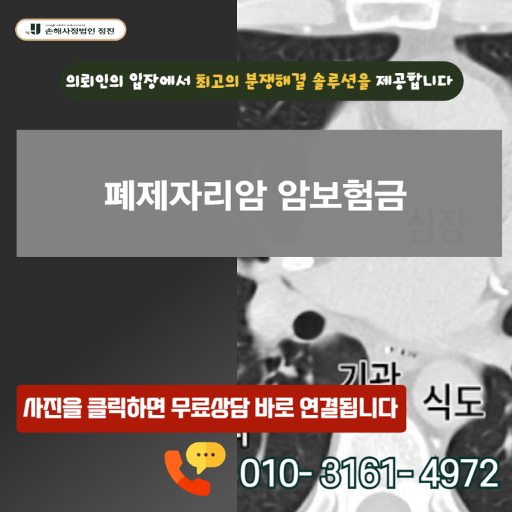  폐제자리암 암보험금, 제자리암 진단인데도 전액 보상 가능했던 결정적 이유