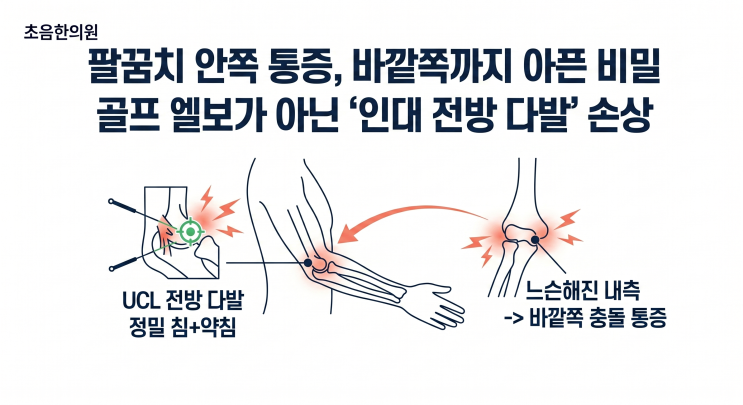  [팔꿈치통증] 골프엘보? 내측측부인대(UCL) 손상과 숨겨진 외측 통증의 비밀