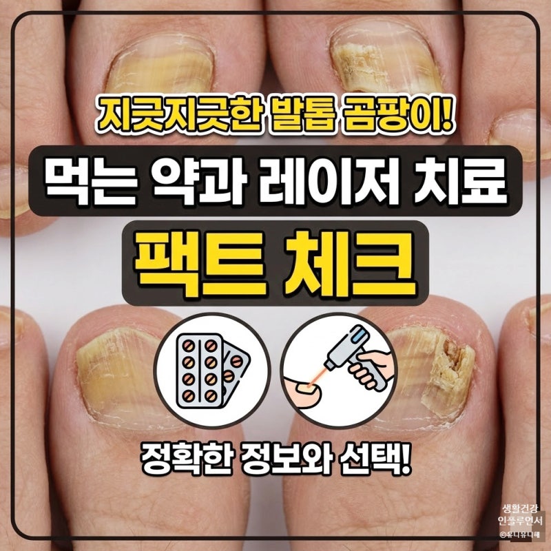 지긋한 발톱 곰팡이, 발톱 무좀 먹는약과 레이저 치료 차이점 비교