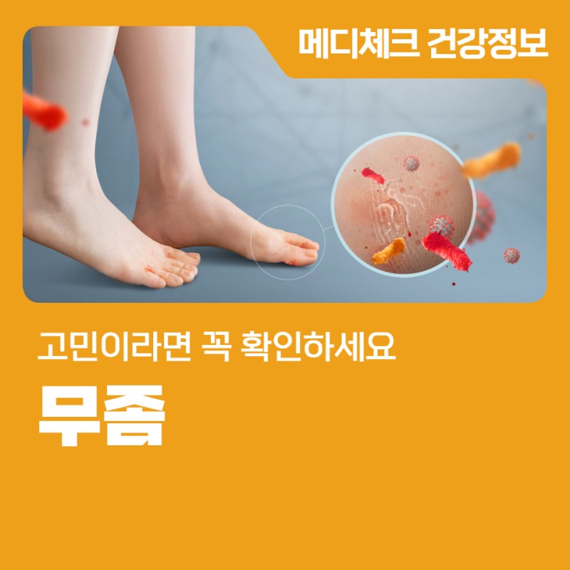 무좀 때문에 고민이라면 꼭 확인하세요