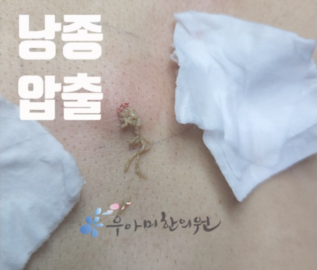 피지낭종 제거 비용 왜 다를까요? 압출•수술 가격 차이