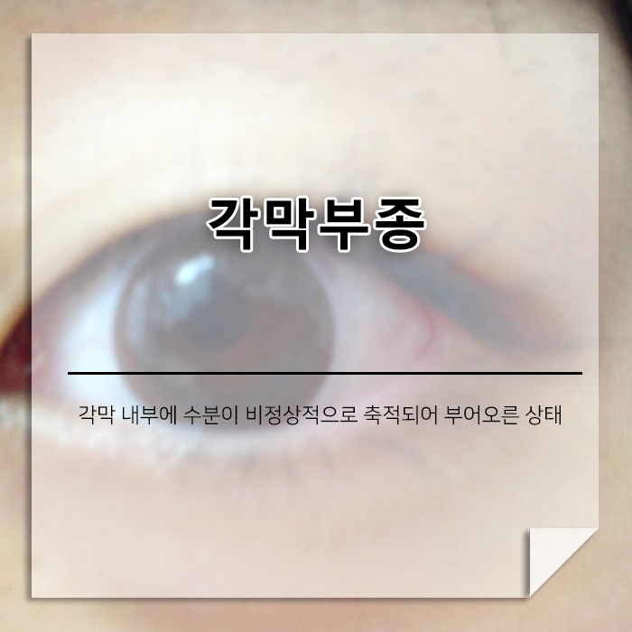 눈이 뿌옇고 빛 번짐이 심하다면? 각막부종