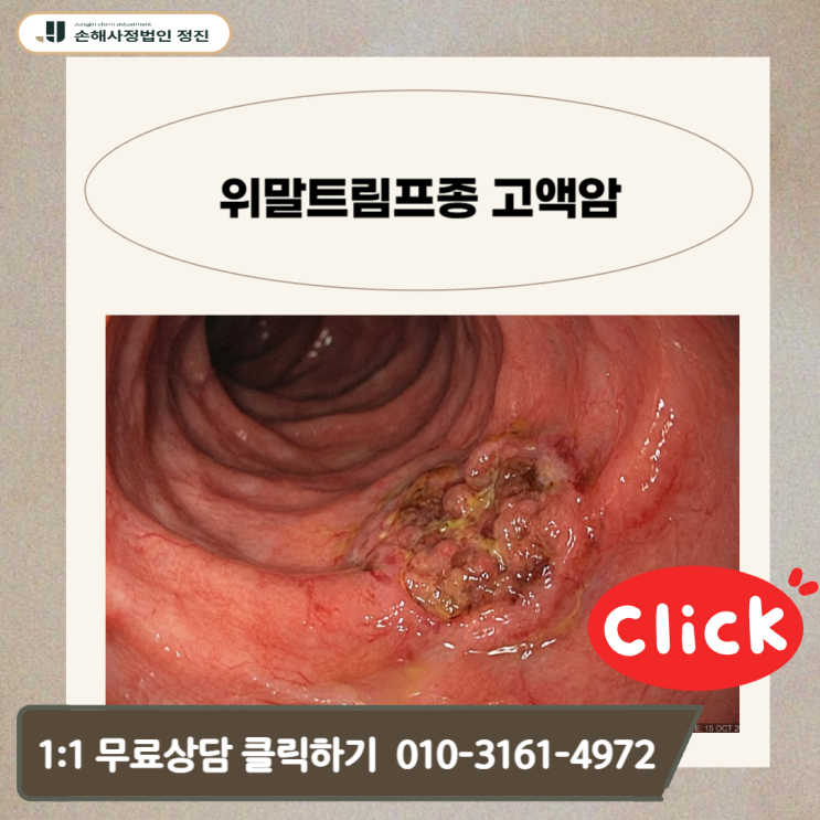  위말트림프종 고액암, 보험사가 숨기는 지급의 비밀 모르면 한 푼도 못 받습니다