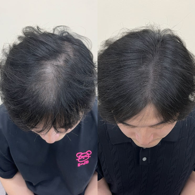  남자 정수리두피문신, 인천 혜지오에서 받아야 하는 이유