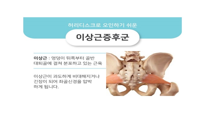 이상근 증후군 초음파검사 pdrn주사치료