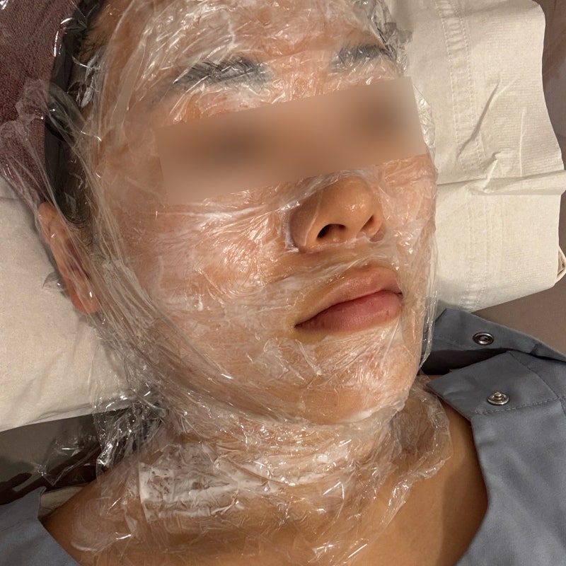 대구편평사마귀무제한 대구쥐젖제거성지 한의원에서 시술 후 다운타임없이 일상복귀