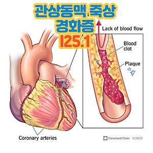 관상동맥 죽상경화증(I25.1) 진단받았는데, 허혈성 심장질환 진단비를 못 준다니요?