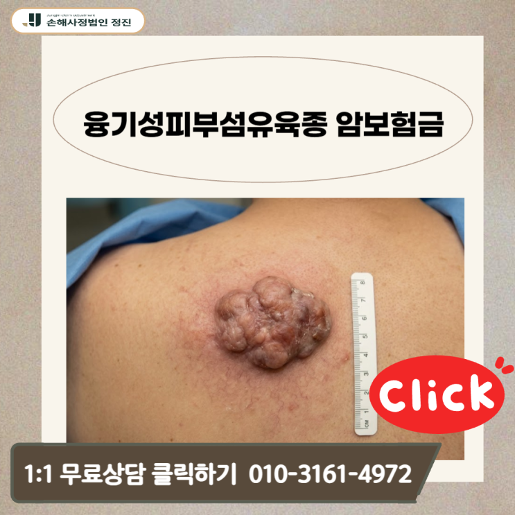  융기성피부섬유육종 암보험금 , 지급 거절을 막는 실전 비법