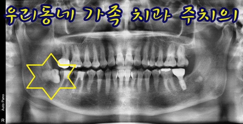 대학병원 의뢰받은 매복 사랑니, 구강외과 전문 더플랜치과 에서 당일 발치한 사례