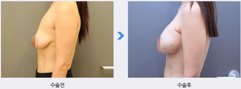 처진가슴수술, 보형물 꼭 넣어야 할까? 21년 차 외과 의사의 기준