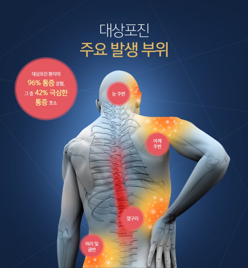 대상포진 골든타임 72시간? 대상포진 초기증상부터 보험청구까지 총정리