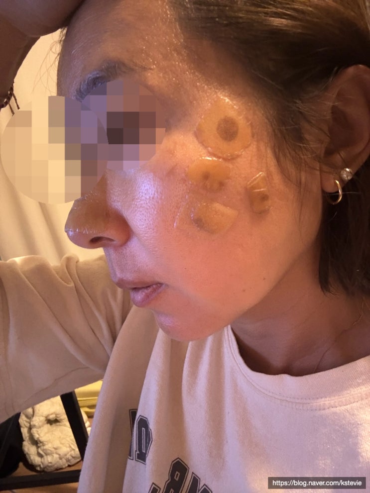  리팟레이저 후기 흑자가 한번에 제거 된다는 말 진짜일까
