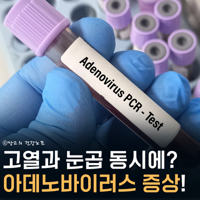 눈곱 감기 아데노바이러스 증상은? | 원인, 전염, 대처법