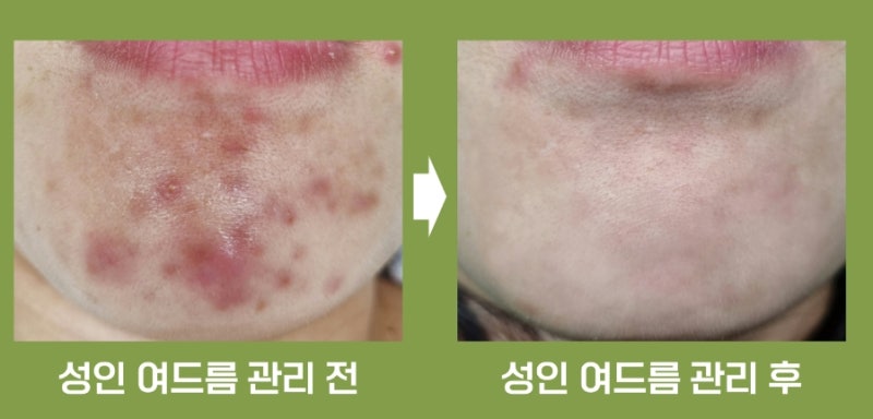 '자궁 탓 그만!' 유독 턱에만 나는 여드름, 방치하면 켈로이드성 여드름 흉터 된다? <용인/ 동....