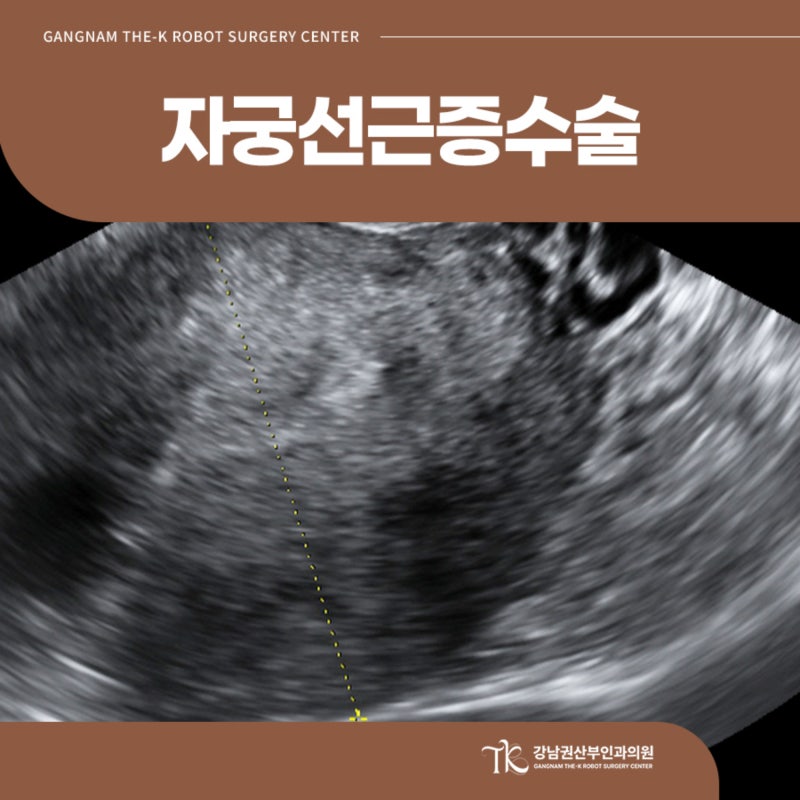 강남 자궁선근증수술 치료 방법 선택 시 꼭 알아야 할 점들