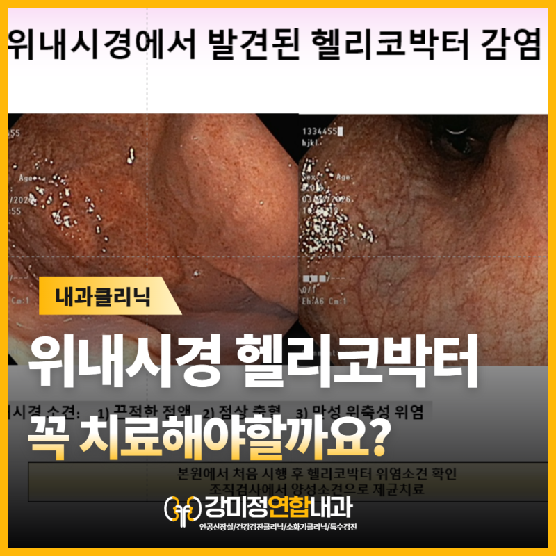 위내시경에서 발견된 헬리코박터균 감염, 꼭 치료해야 할까요?