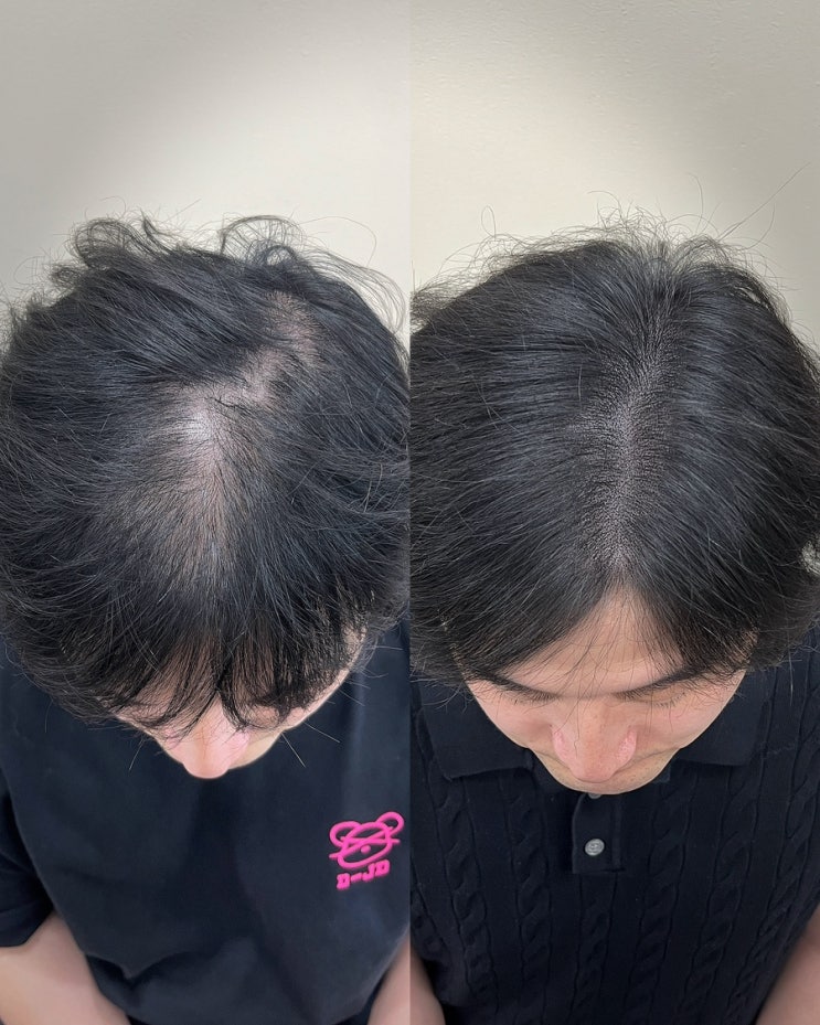  인천두피문신, 미용실 원장도 몰라본 자연스러운 SMP 커버 후기
