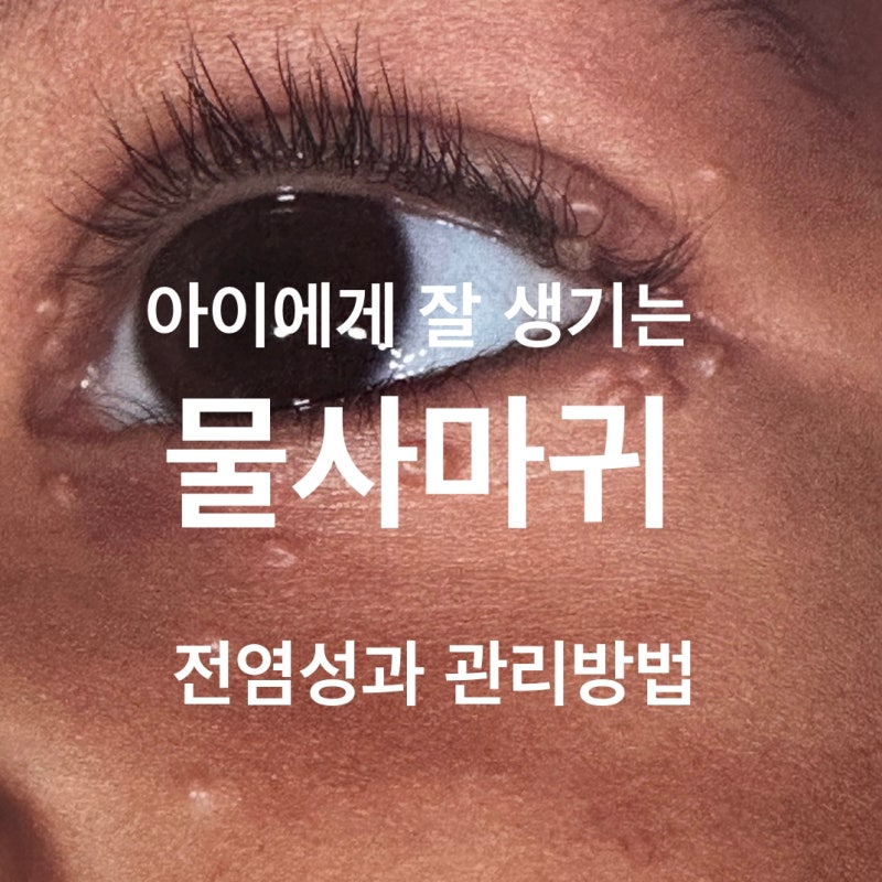 대구 물사마귀 제거 피부과 치료 원인 증상까지 칠곡 장재원 피부과 의원