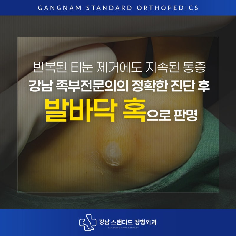 반복된 티눈 제거에도 지속된 통증, 강남 족부전문의 정확한 진단 후 발바닥 혹으로 판명