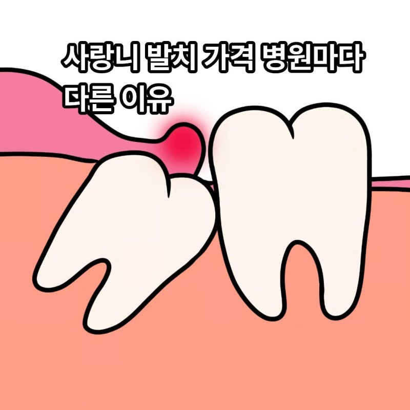 사랑니 발치 가격 치과마다 다른 이유 ?
