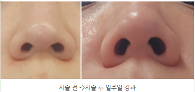  [안양성형외과] 경기도권에서 제일 큰 성형외과 가서 코 조각주사 받고 온 후기!