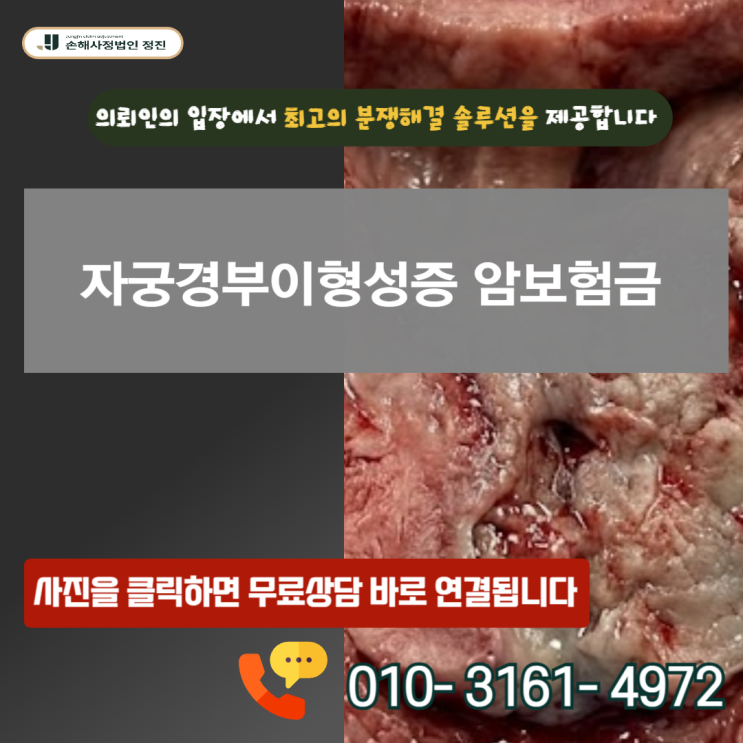  자궁경부이형성증 암보험금, CIN2 지급 거절을 해결한 방법
