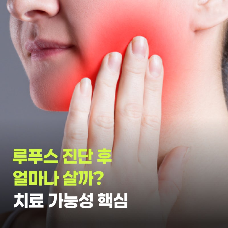 루푸스 진단 후 얼마나 살까? 치료 가능성 핵심