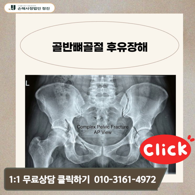  골반뼈골절 후유장해, 숨겨진 지급 조건? 나만 모르면 손해 보는 이유는 무엇일까요?