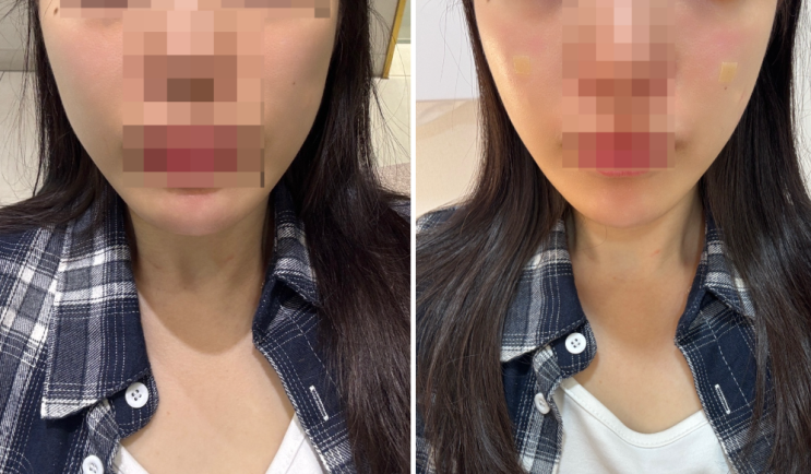  강남역 쥬베룩 볼륨 후기 앞볼 옆볼 솔직후기 얼굴라인 변화 대박