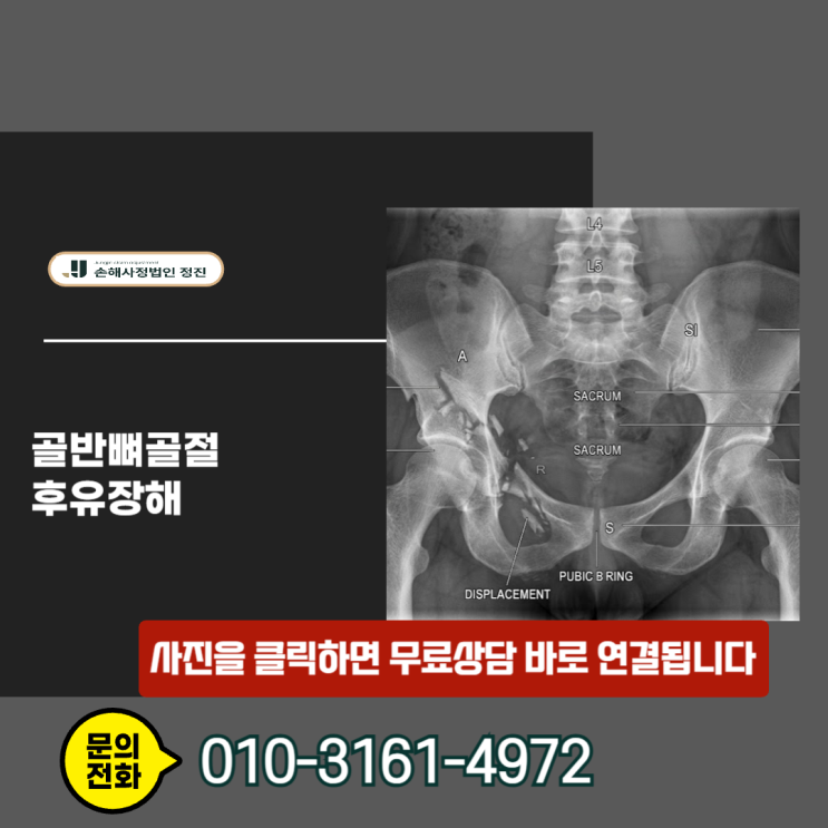  골반뼈골절 후유장해, 숨겨진 보험금과 까다로운 보상 절차 속에서 권리를 찾는 방법