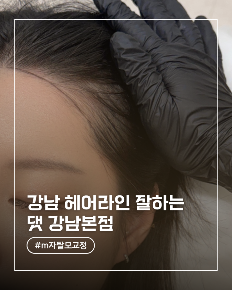  강남헤어라인 후기 M자탈모 자연스럽게 채운 리얼후기