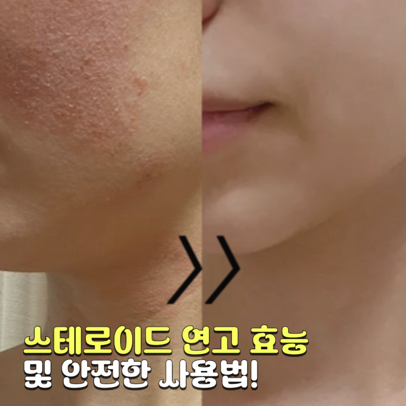 프로토픽 부작용 스테로이드 연고 효능 및 안전한 사용법!