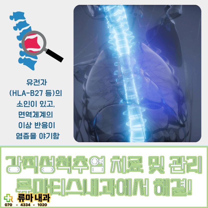 서울 영등포 강직성 척추염 원인 면역 체계의 이상과 유전적 요인 알아보기