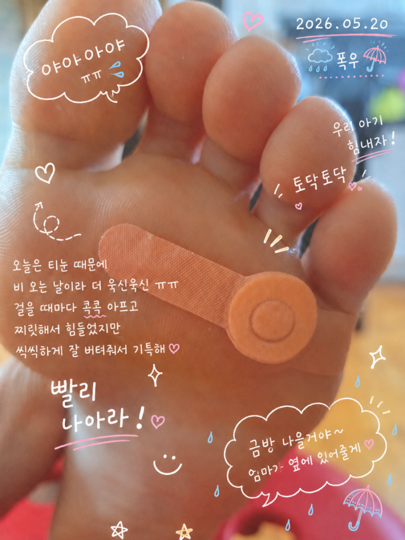약국 티눈 밴드 실패 없이 핵심 '원뿔 핵' 뽑는 법 발바닥 티눈 원인과 예방