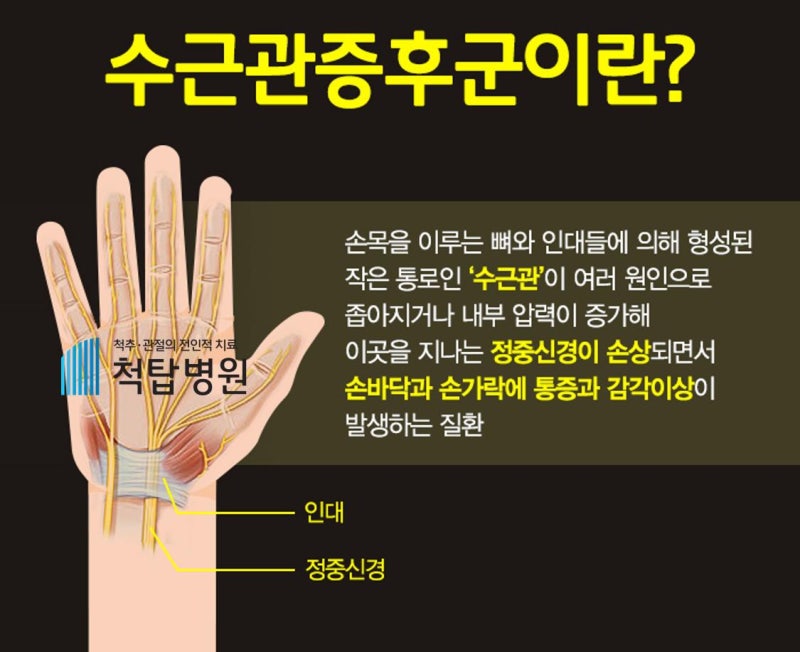 대구 손목통증 단순 근육통일까? 손목터널증후군 병원 진단이 중요한 이유