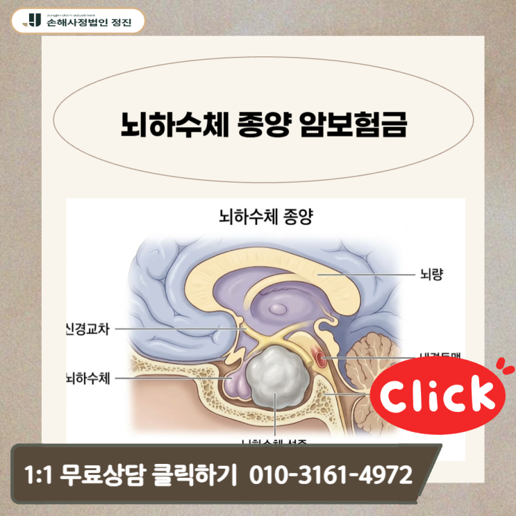  뇌하수체 종양 암보험금, D35.2 양성 코드 뒤에 숨은 일반암 지급의 실마리를 찾아서