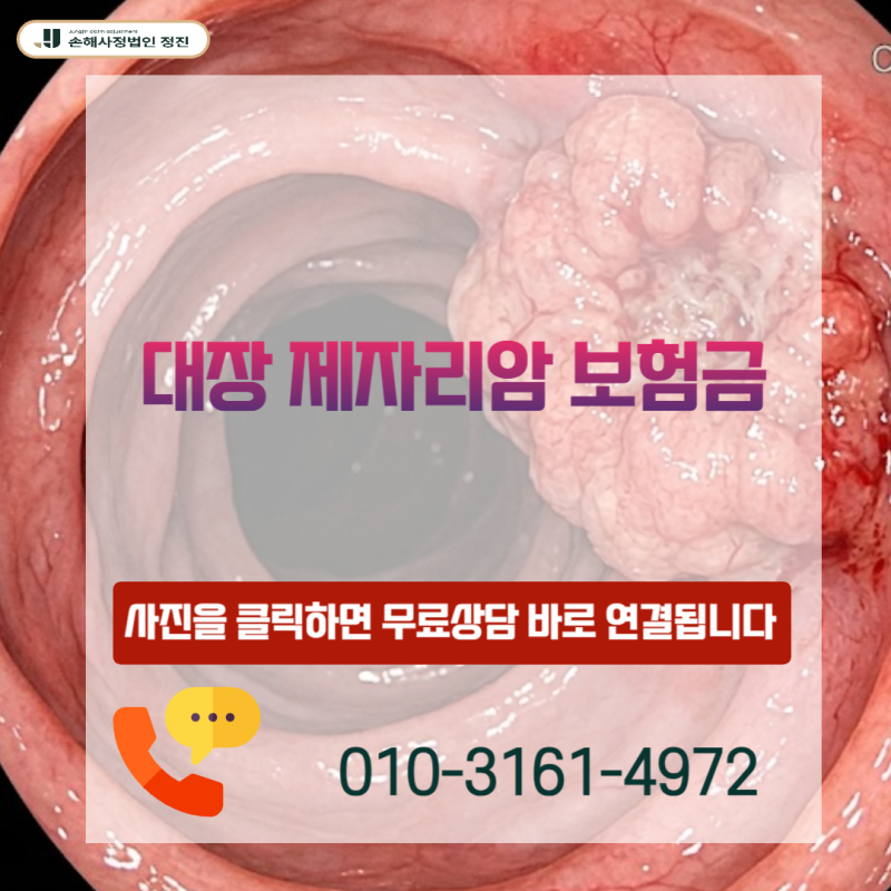 대장 제자리암 보험금, 소액암 10% 지급 통보, 여기서 끝이 아닐 수 있습니다