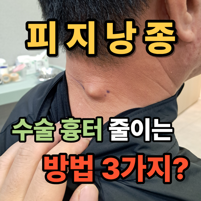 하남 피지낭종 수술 흉터 줄이는 방법 3가지? (강동중앙 내과외과)