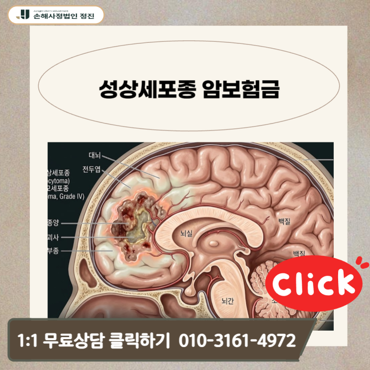  성상세포종 암보험금, D코드 경계성종양도 일반암 전액 청구 가능한 실무 전략
