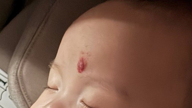 혈관종 ① 혈관종 뜻과 생기는 이유 [아기 혈관종 / 영아 혈관종 / 딸기 혈관종 / 혈관종 증상 ....