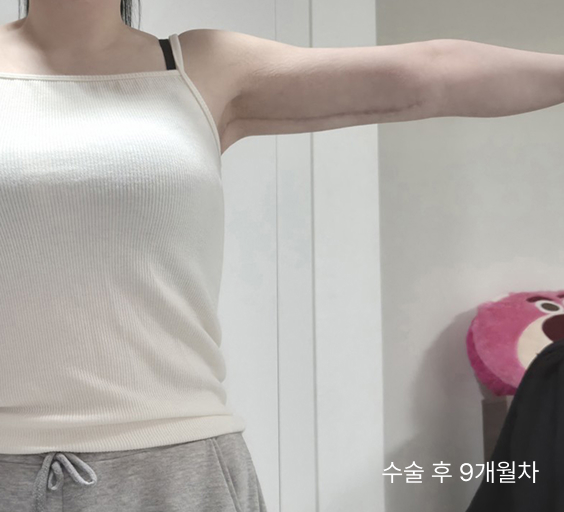  팔거상으로 해결하는 팔뚝 처짐, 흉터 최소화와 매끄러운 라인을 만드는 핵심 기술은?